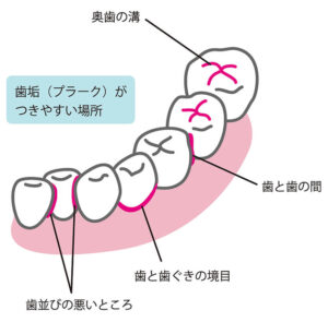 プラークがつきやすい場所