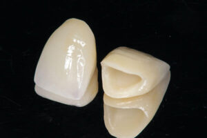 詰め物や被せ物に使われる素材