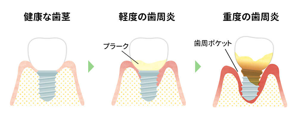 インプラント周囲炎
